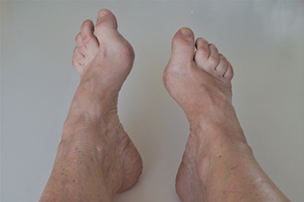 High Arch Foot Pain Can Affect Balance and Mobility