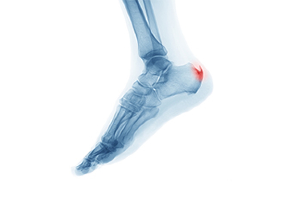 Two Categories of Heel Spurs