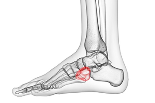 What Can Cause Cuboid Syndrome?