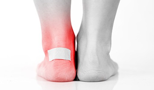 How Footwear Can Lead to Blisters