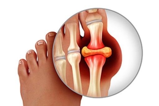 Everything You Need to Know About Gout