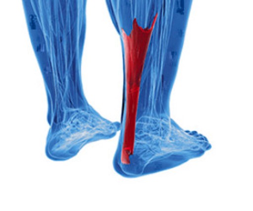 What are Achilles Tendon Injuries