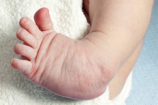 When Does Clubfoot Develop Blog when-does-clubfoot-develop-blog