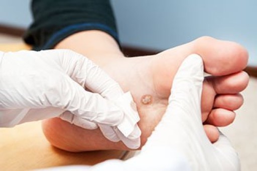 All About Plantar Warts