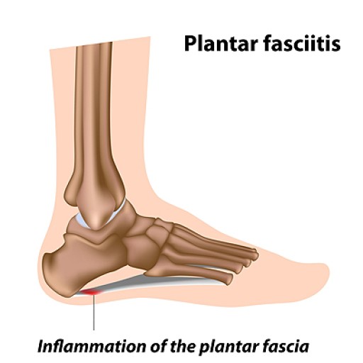 How Does Plantar Fasciitis Make the Heel Hurt? Blog