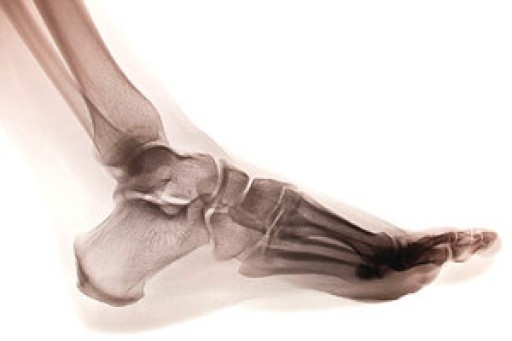 Definition and Causes of a Foot Stress Fracture