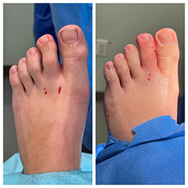 minimally invasive bunion surgery