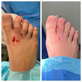 minimally invasive bunion surgery