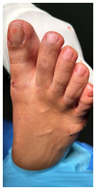 minimally invasive bunion surgery